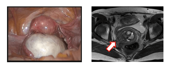 卵巣機能低下を最小限にとどめる卵巣子宮内膜症性嚢胞（左）手術、深部内膜症（右）